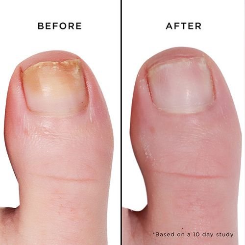 Nail Health before and after (2)