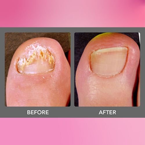 Nail Health before and after (3)