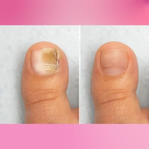 Nail Health before and after (4)