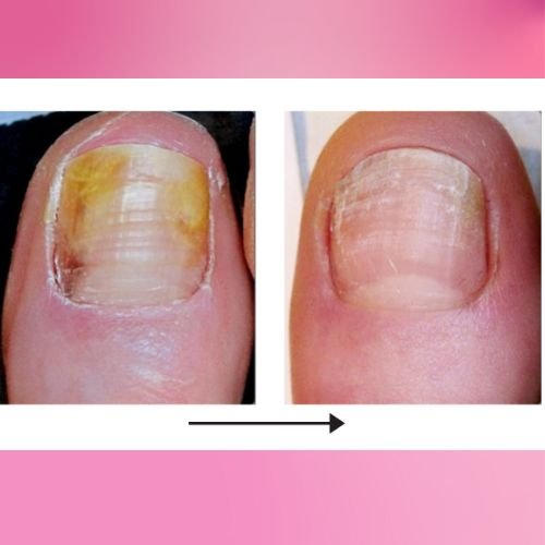 Nail Health before and after